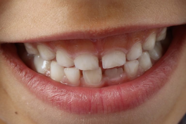denti bambini